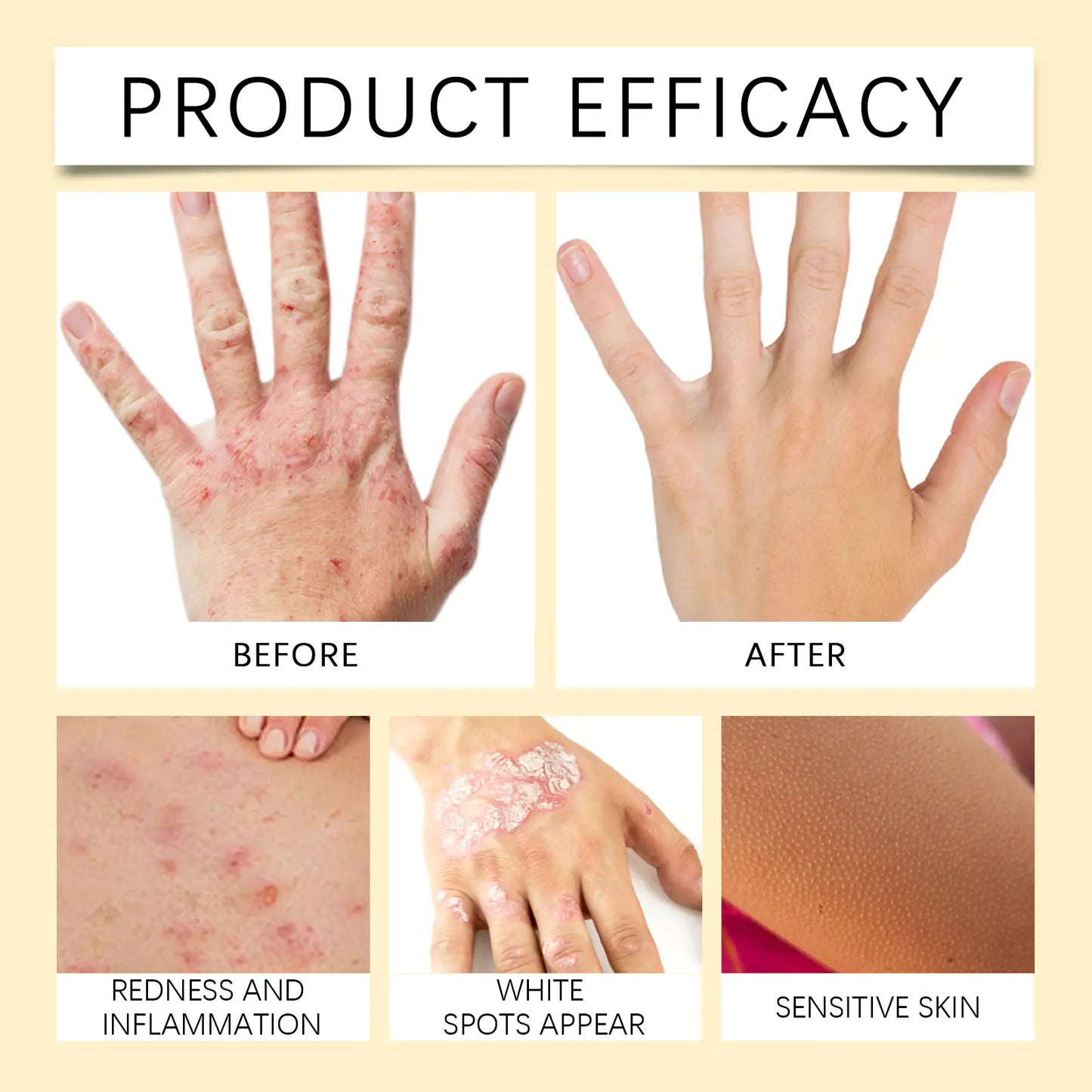 Bee White Spot Neck Cream - Natural Skin Repair for Neck Discoloration | Reduce White Spots & Even Skin Tone with Bee Venom