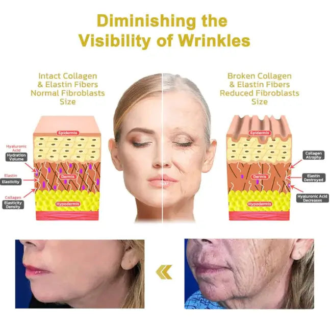 Diminishing the visibility of wrinkles with intact collagen and elastin fibers, showcasing bee venom anti-aging cream effects.